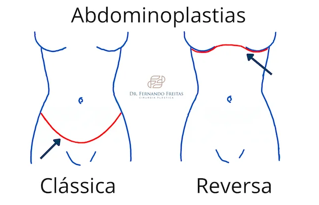 Comparativo das cicatrizes da abdominoplastia tradicional e da abdominoplastia reversa