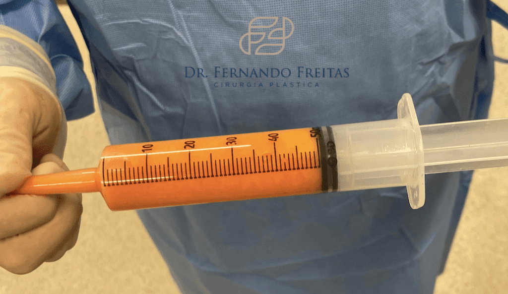 Lipoenxertia: Antes e Depois - entenda mais sobre esta cirurgia!