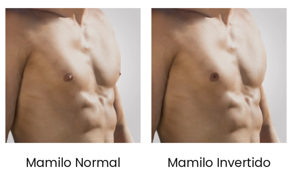 Mamilo invertido em homem