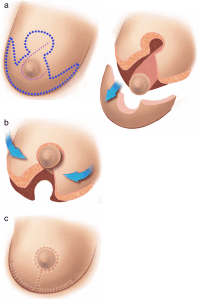 Desenho esquemático de como é feita a mamoplastia redutora