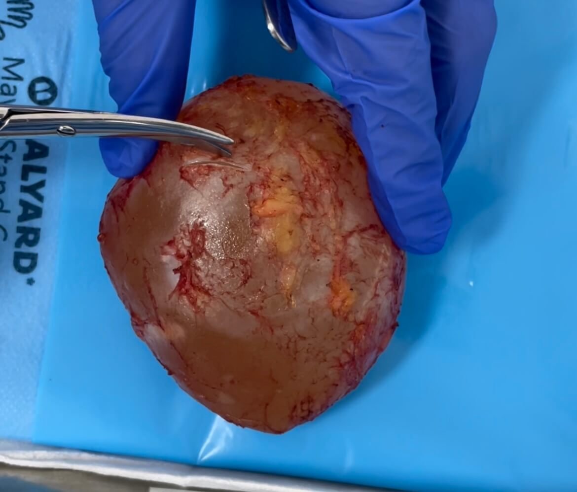 Cápsula fibrosa retirada junto com a prótese de silicone durante um explante mamário