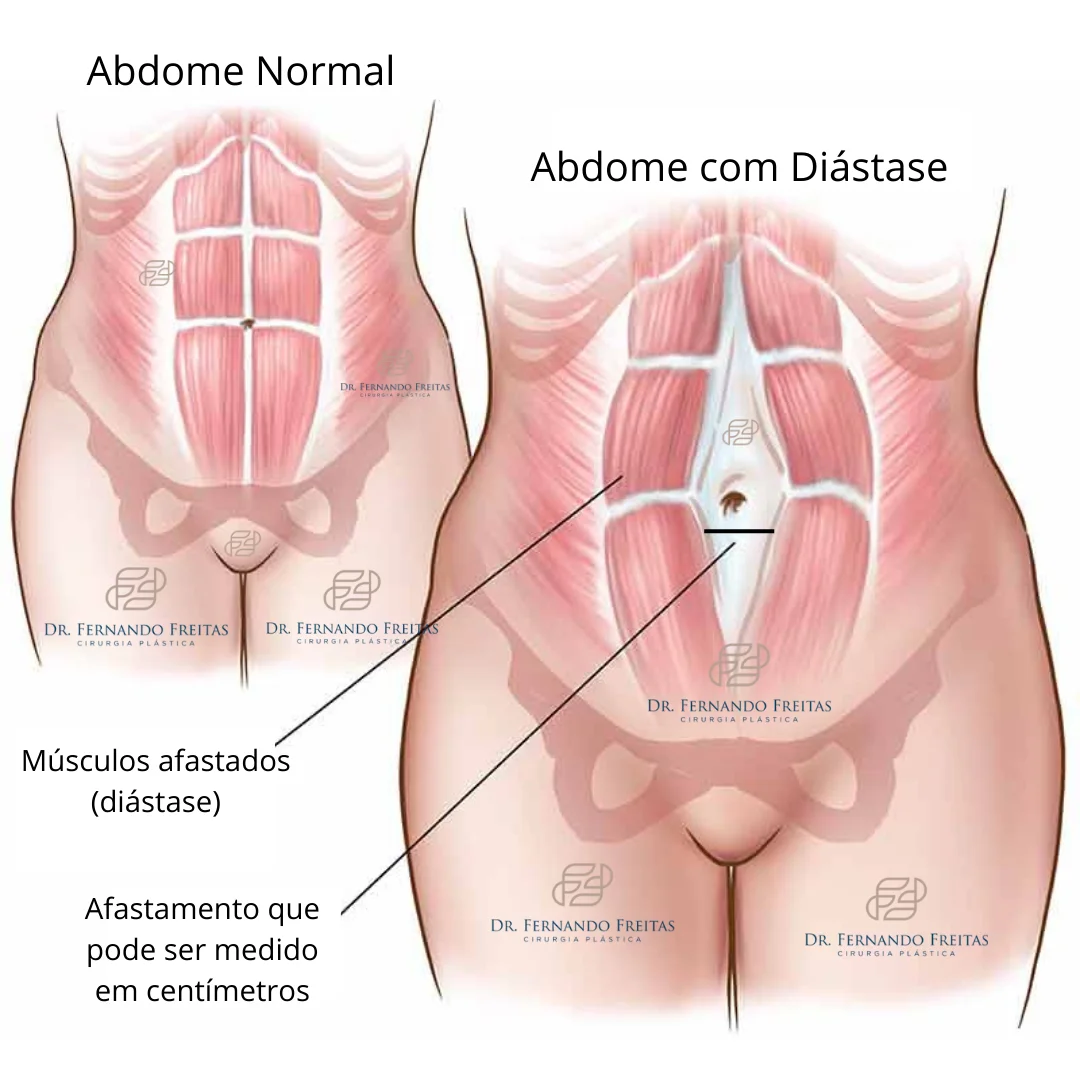 Ilustração comparando abdome normal e abdome com diástase, uma das causas do estômago alto