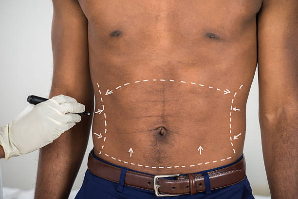 Dr Edson Guerra - Quais são os benefícios da Sua Lipo abdominal? A Sua Lipo  (lipoaspiração) abdominal diminui o abdômen, reduz e aplaina o estômago  (barriga superior), a parte baixa do abdômen