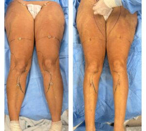 Lipedema antes e depois - dr. Fernando Freitas