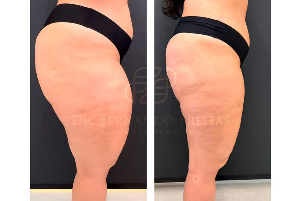 Tratamento De Linfedema Antes E Depois Lipedema No Tornozelo: