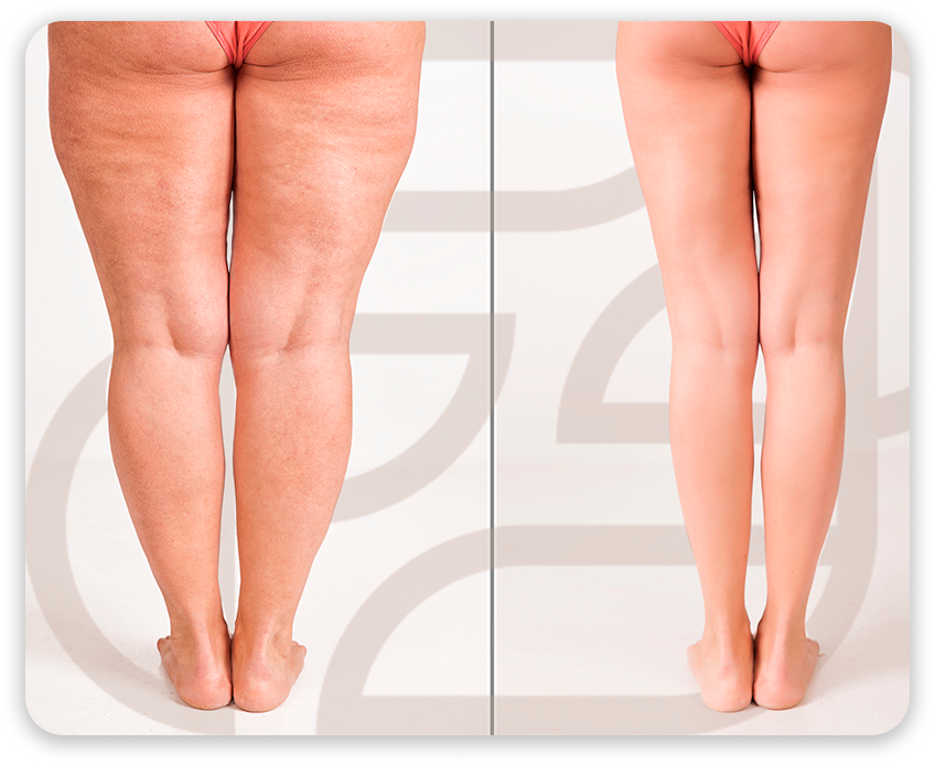 Meia de compressão para lipedema: qual pressão usar e por quanto tempo