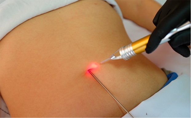 Lipo laser