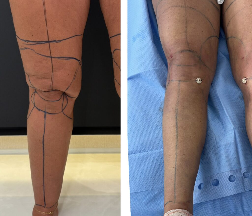 Lipedema de Joelho antes e depois da cirurgia