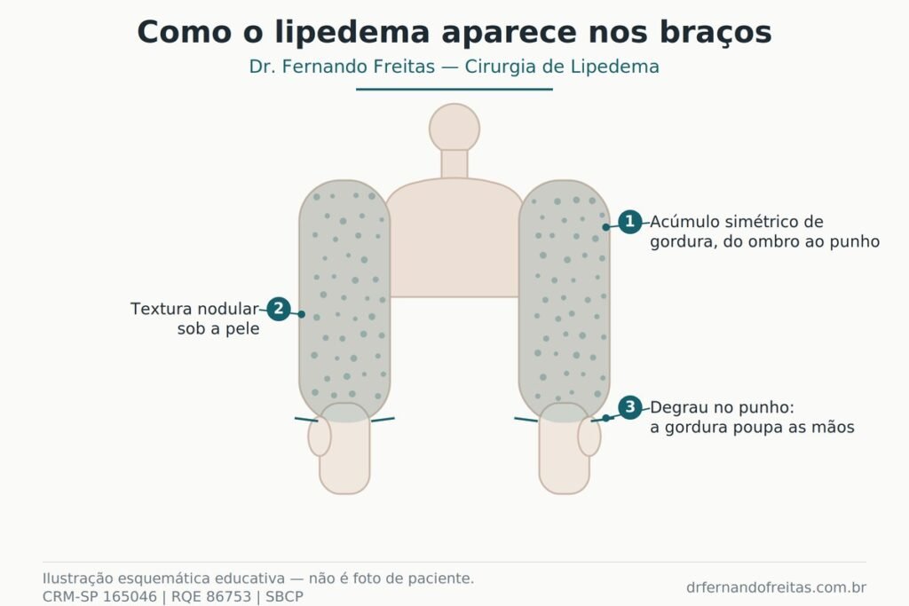 lipedema-nos-braços