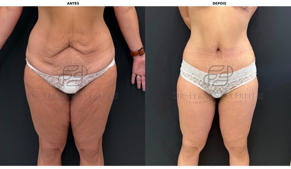 Comparação antes e depois de cruroplastia mostrando redução da flacidez nas coxas e abdômen