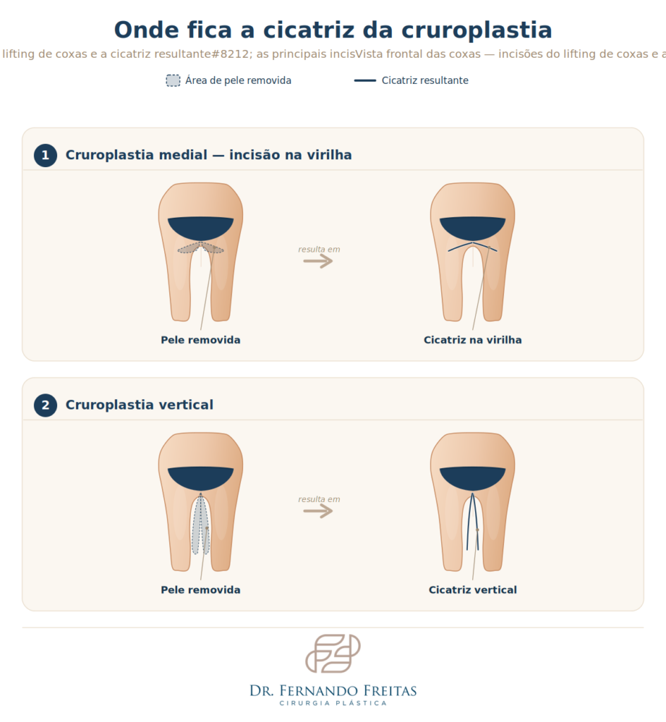 Infográfico anatômico mostrando onde fica a cicatriz da cruroplastia nas incisões medial e vertical