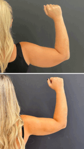 Lipedema-de-braços-antes e depois