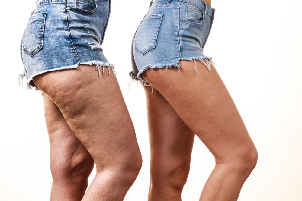 Drenagem linfática no pós-operatório de lipedema: guia