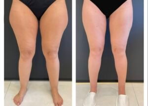 lipedema de culotes