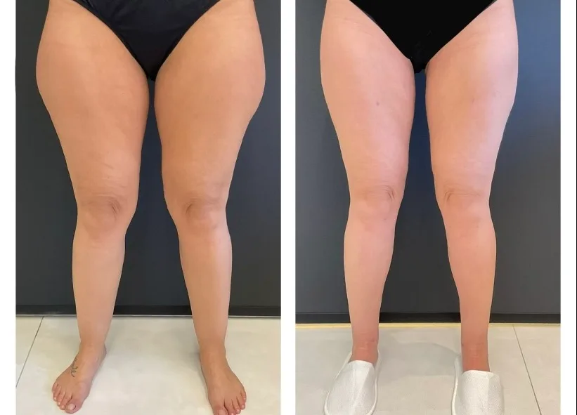 lipedema de culotes