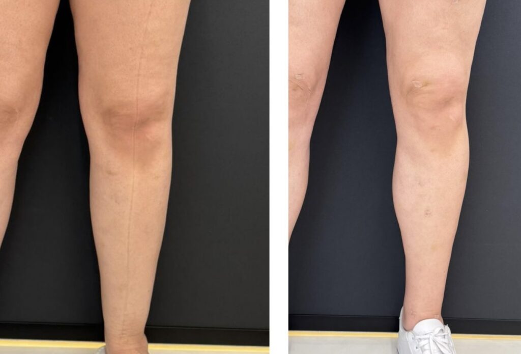 Lipedema Tornozelo antes e depois