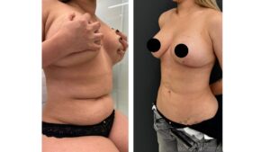 Imagem ilustrativa de antes e depois da lipoescultura 