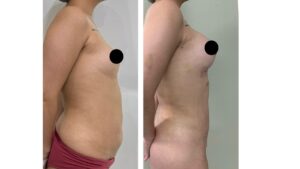 Imagem ilustrativa de antes e depois da lipoescultura 