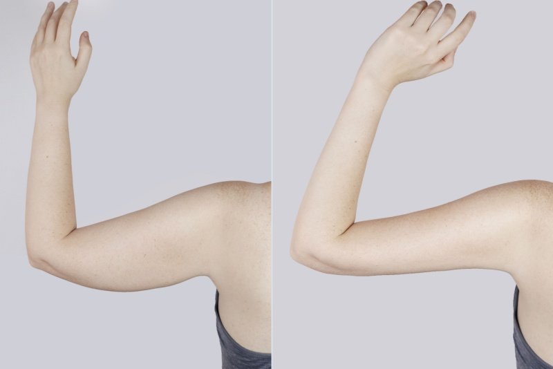 Como é o antes e depois da braquioplastia?
