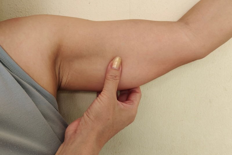 Cicatriz da braquioplastia: quais cuidados tomar?