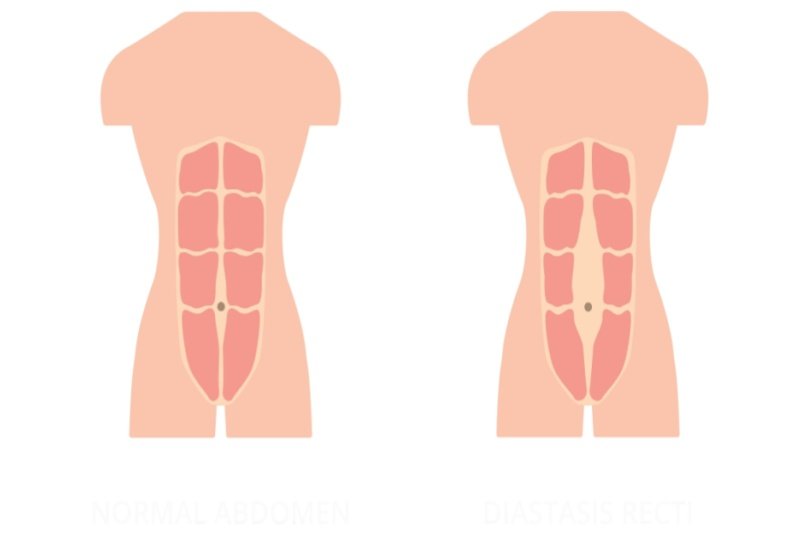 Diástase abdominal em homem: causas, sintomas e tratamentos