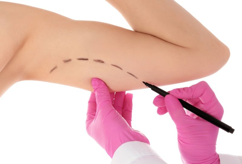 Qual o valor da braquioplastia em 2026?