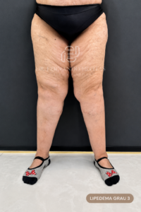 lipedema-grau-3