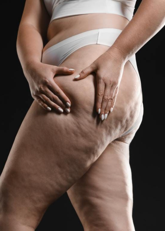 Fibrose após lipoaspiração de lipedema: como identificar, prevenir e tratar