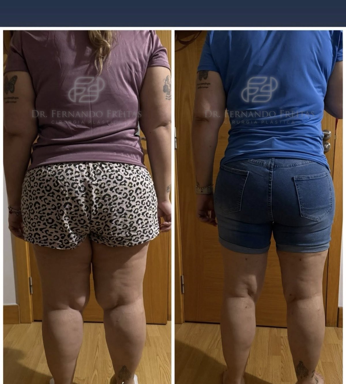 Lipedema-grau-3-antes-e-depois