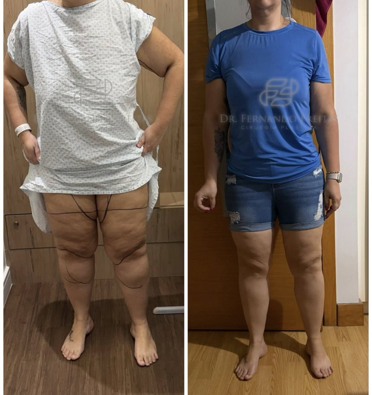 lipedema-grau-3-antes-e-depois
