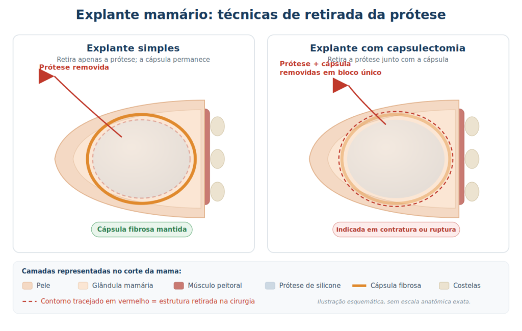 Ilustração de explante mamário comparando explante simples e explante com capsulectomia