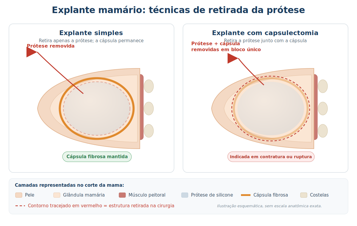 Ilustração comparando explante simples e explante com capsulectomia no tratamento da doença do silicone