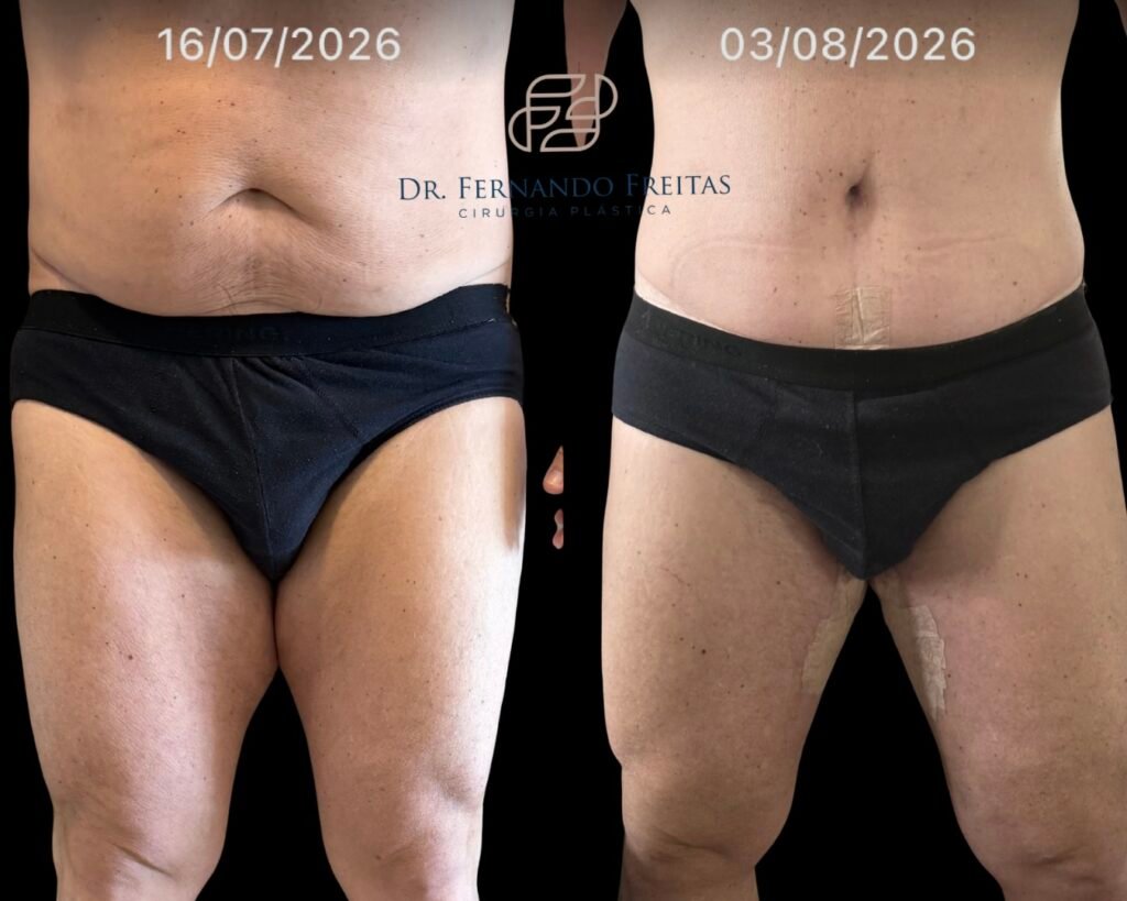 Resultado de cruroplastia masculina na face interna da coxa após grande perda de peso