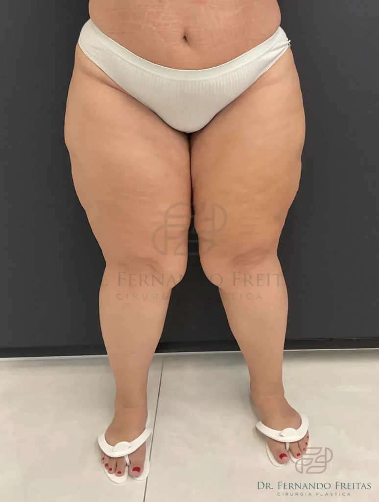 Lipedema grau 3 com acúmulo simétrico de gordura em coxas e pernas, poupando os pés
